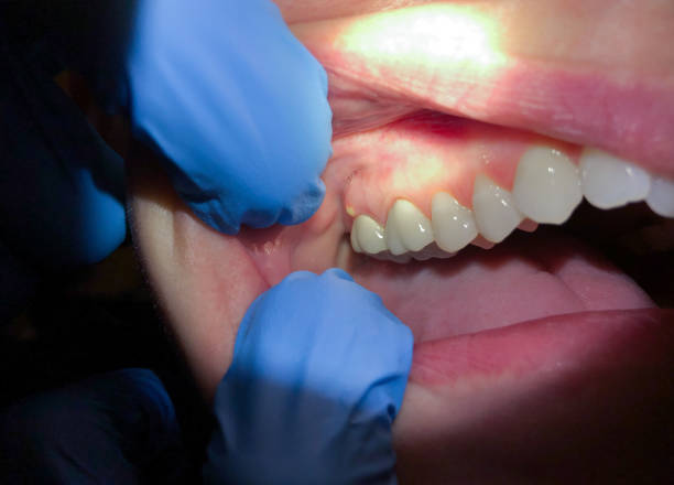Best Emergency Tooth Extraction in Jim Thorpe, PA